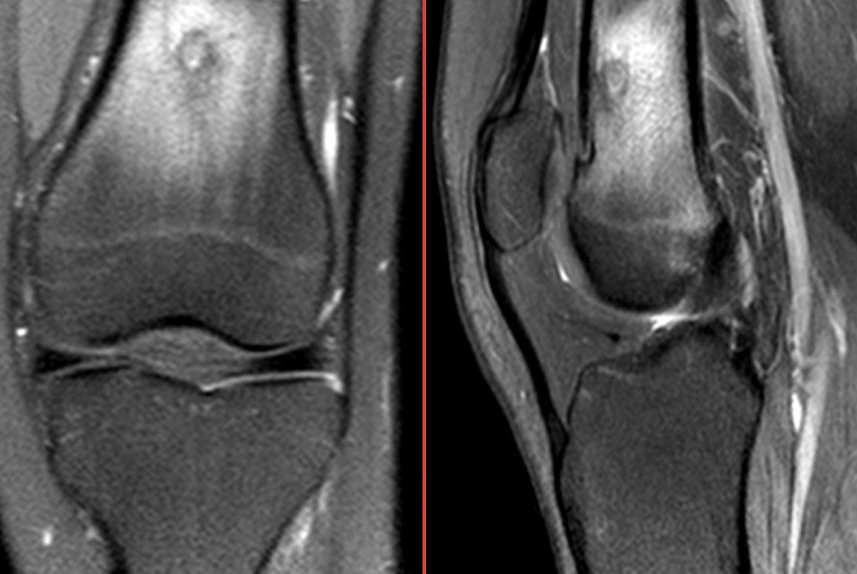 Figure 4 for case osteoid osteoma ( RID4005 )